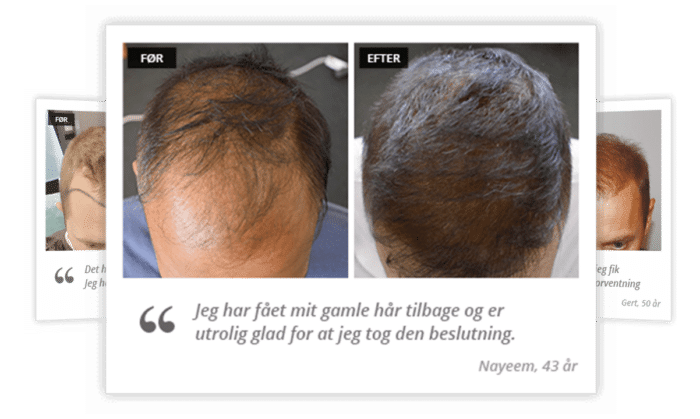 lemmer Hick Smuk kvinde 🥇 Hårtransplantation • Alt den vigtigste viden (August 2022)